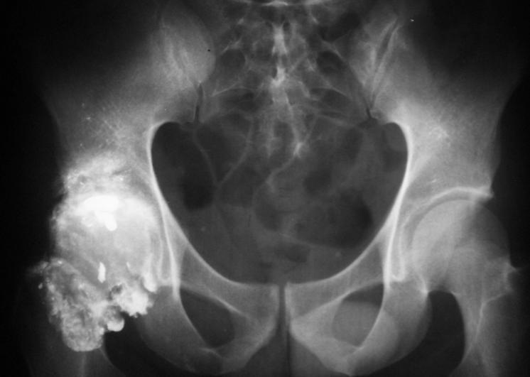 Gun Shot Wounds Trauma Orthobullets